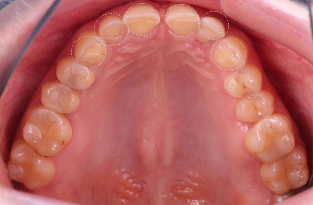 Detection of dental attrition 6 Detection of dental attrition 5