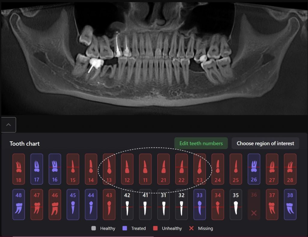 Detection of dental attrition 4 Detection of dental attrition 3