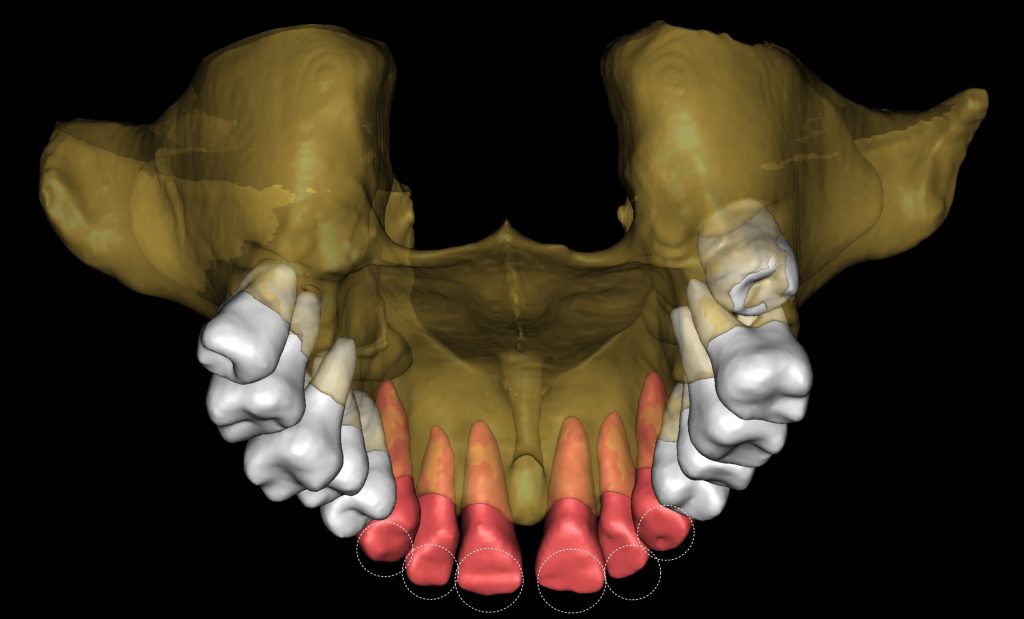 Detection of dental attrition 2 Detection of dental attrition 1