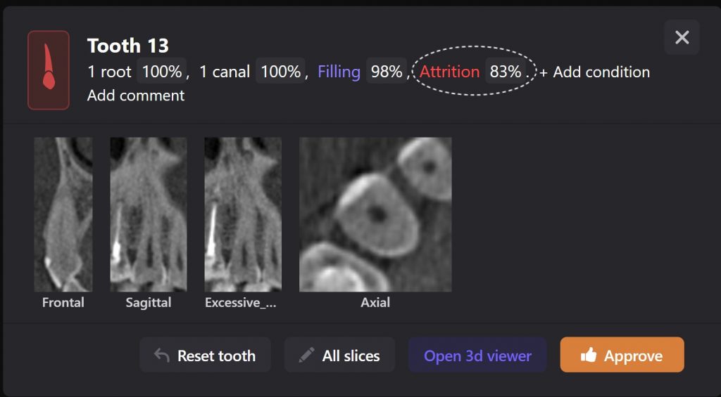 Detection of dental attrition 8 Detection of dental attrition 7