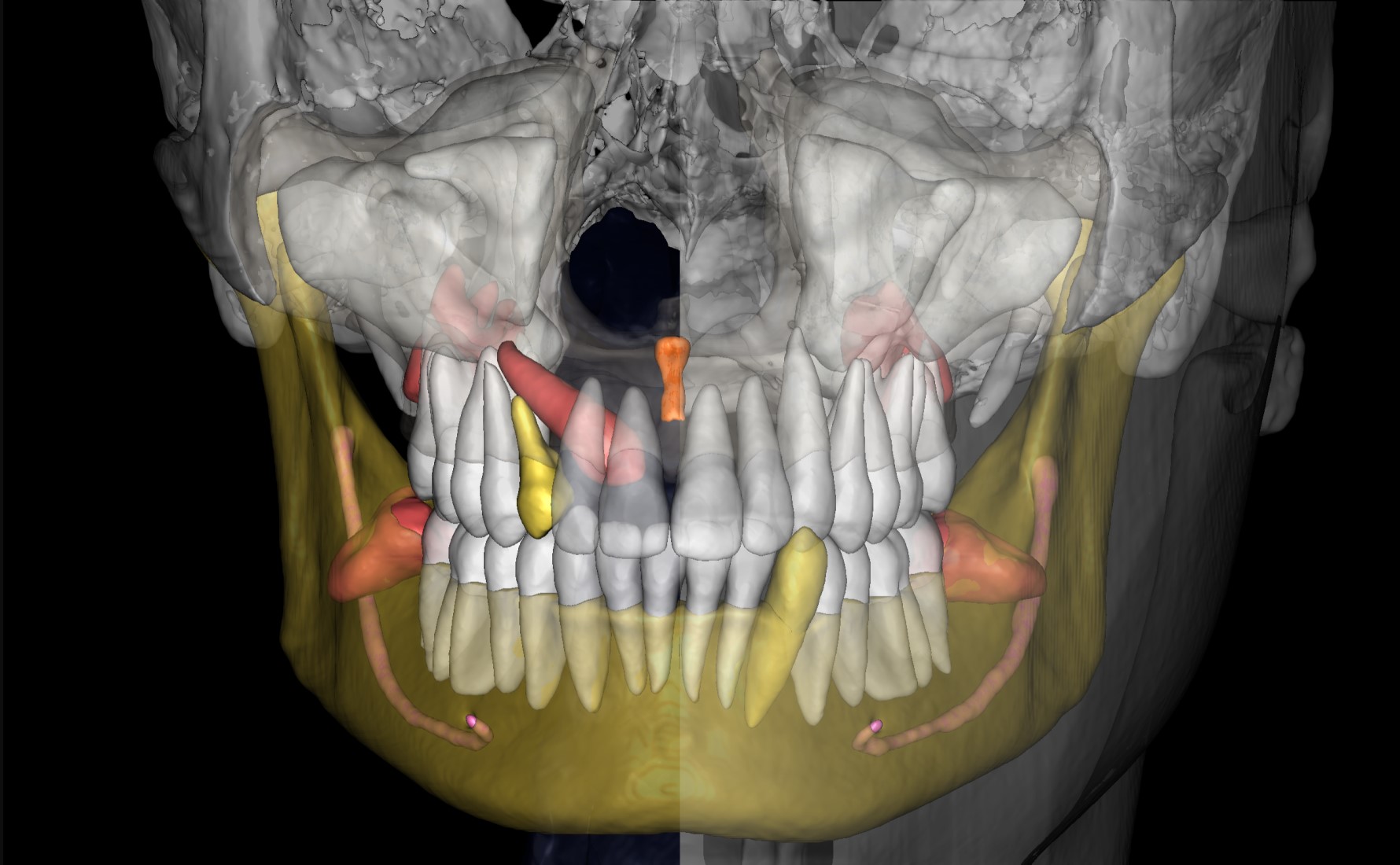 CBCT Segmentation 1 Orthodontist Case 1