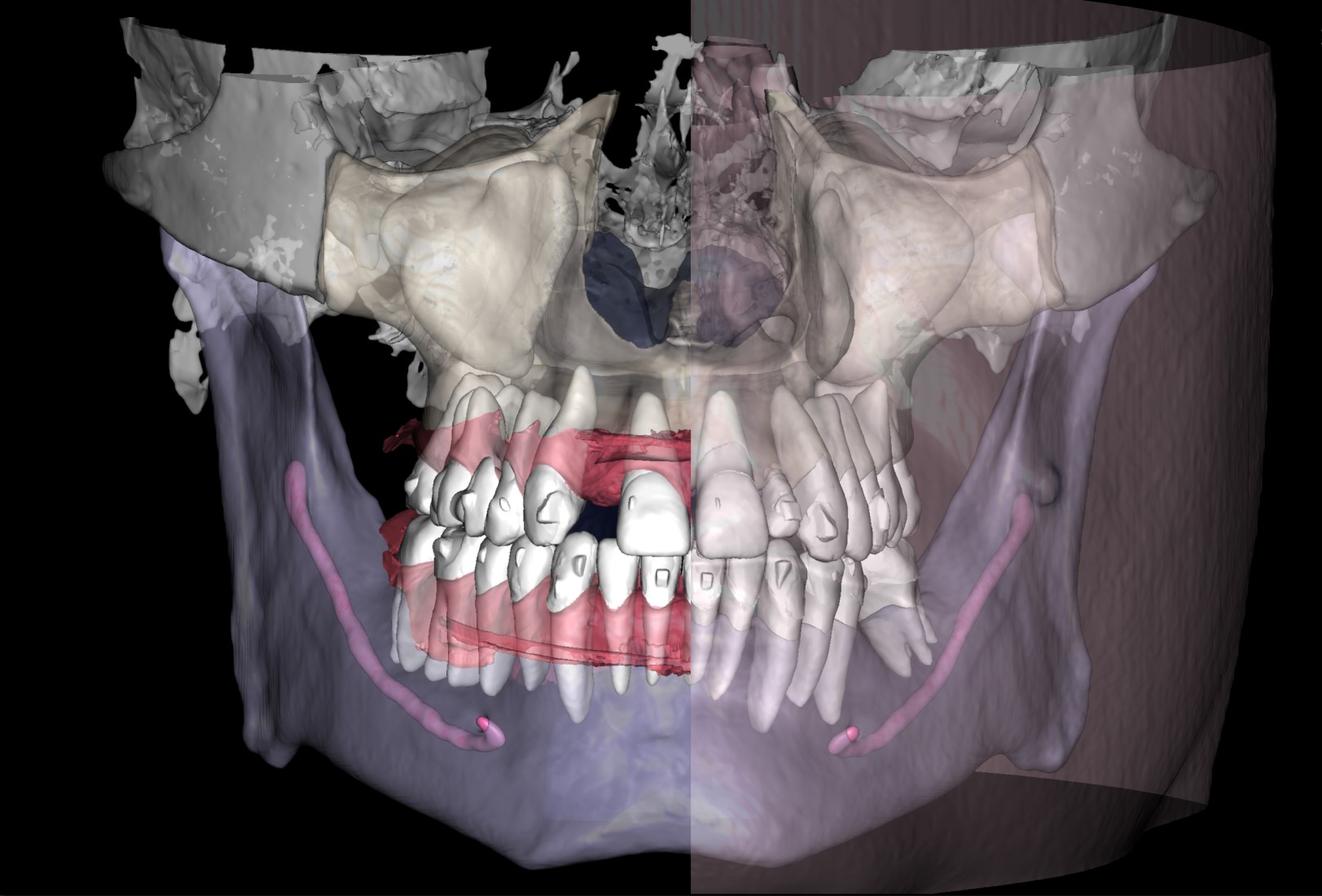 CBCT Segmentation 4 Orthodontist Case 2
