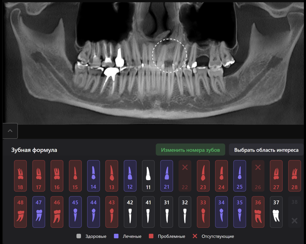 Планирование имплантации зуба в эстетически важной зоне 2 Планирование имплантации зуба в эстетически важной зоне 1