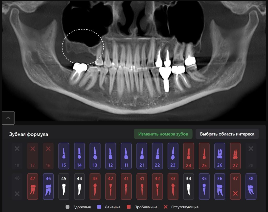 Планирование имплантации 2 Планирование имплантации 1