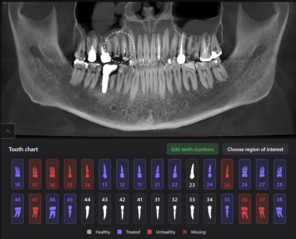 Fallstudie - Kieferorthopädischer Behandlungsplan nach Zahnextraktion 2 Fallstudie - Kieferorthopädischer Behandlungsplan nach Zahnextraktion 1