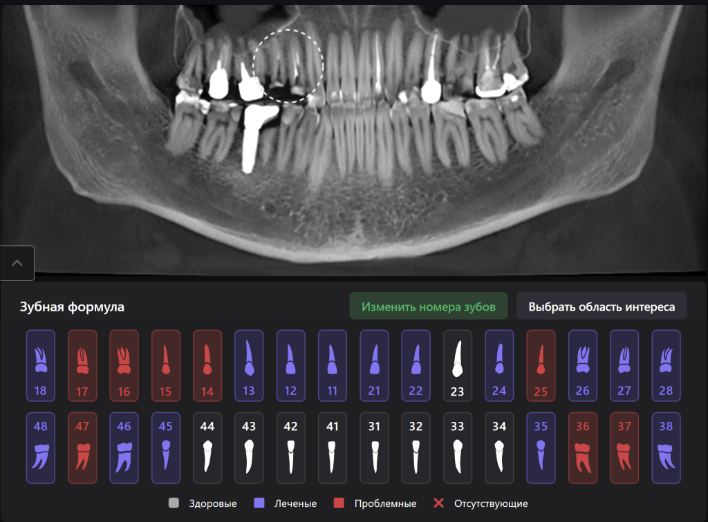 Случай из практики - экструзия зуба с помощью ортодонтической конструкции 2 Случай из практики - экструзия зуба с помощью ортодонтической конструкции 1