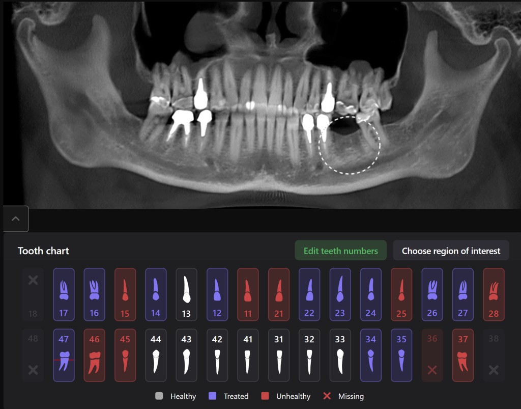 Case study - Implant planning supported with Diagnocat AI 2 Case study - Implant planning supported with Diagnocat AI 1