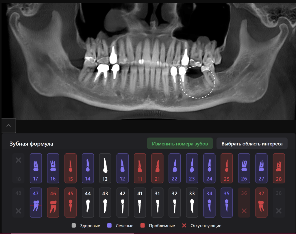 Случай из практики - планирование имплантации вместе с ИИ Diagnocat 2 Случай из практики - планирование имплантации вместе с ИИ Diagnocat 1