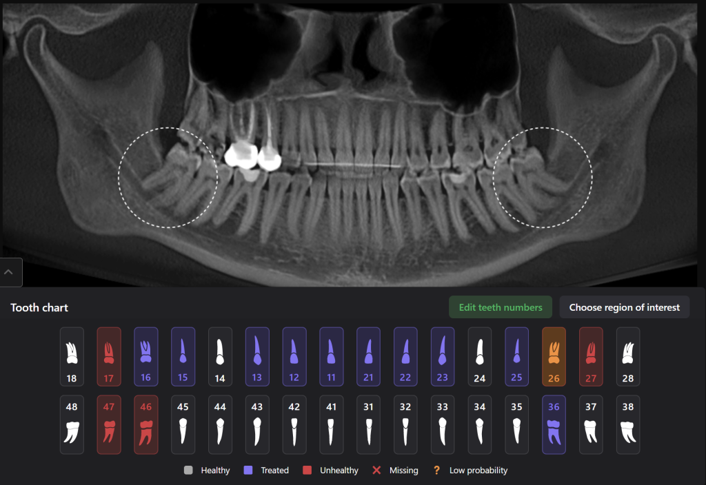Case study - Treatment plan for atraumatic extractions 2 Case study - Treatment plan for atraumatic extractions 1