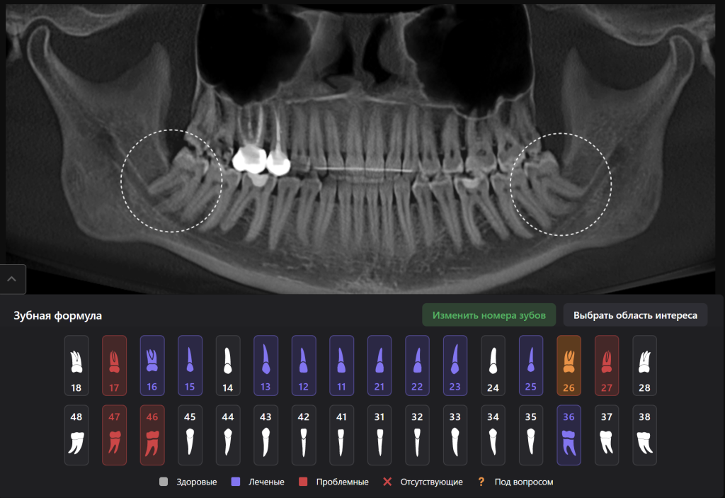 Пример из практики - планирование атравматичного удаления 8 зубов 2 Пример из практики - планирование атравматичного удаления 8 зубов 1