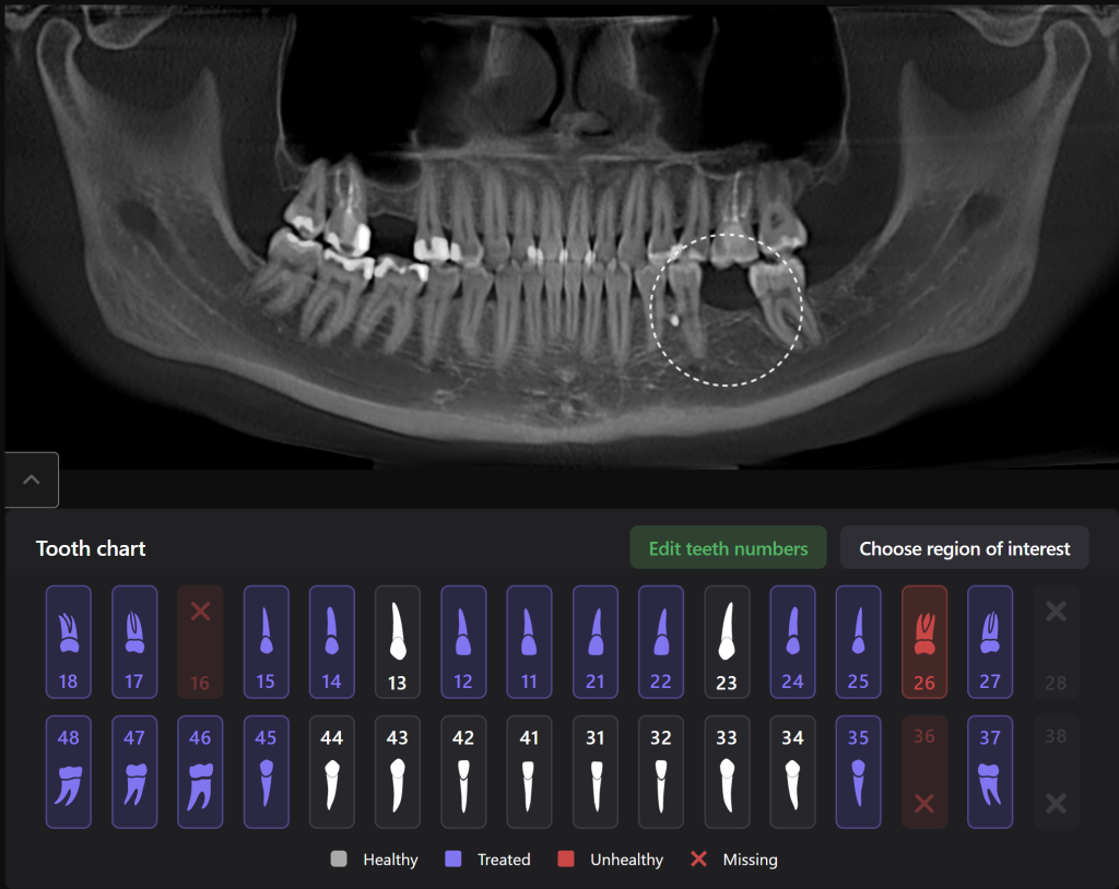 Case study: Implant planning for missing 36 (Universal 19) 2 Case study: Implant planning for missing 36 (Universal 19) 1