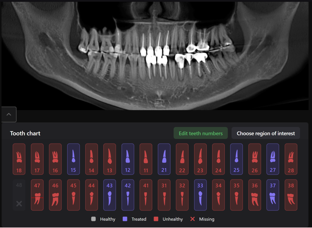 Total prosthetic rehabilitation - case study 2 Total prosthetic rehabilitation - case study 1