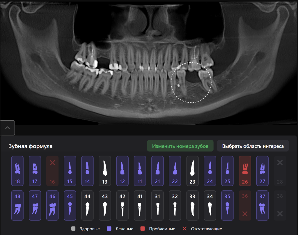 Пример из практики - планирование имплантации в области зуба 3.6 2 Пример из практики - планирование имплантации в области зуба 3.6 1