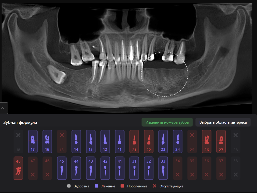 Пример из практики - планирование реконструкции альвеолярного гребня вместе с Diagnocat 2 Пример из практики - планирование реконструкции альвеолярного гребня вместе с Diagnocat 1
