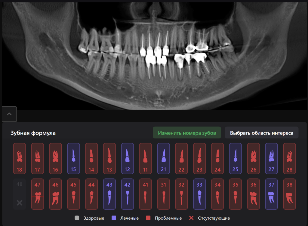 Случай из практики - планирование тотальной ортопедической реабилитации 2 Случай из практики - планирование тотальной ортопедической реабилитации 1