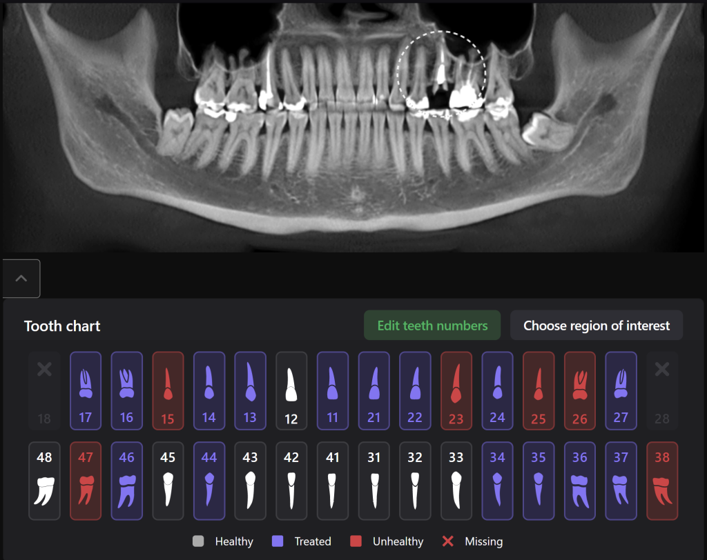 Case study: Implant planning for missing tooth 25 (universal 13) 2 Case study: Implant planning for missing tooth 25 (universal 13) 1