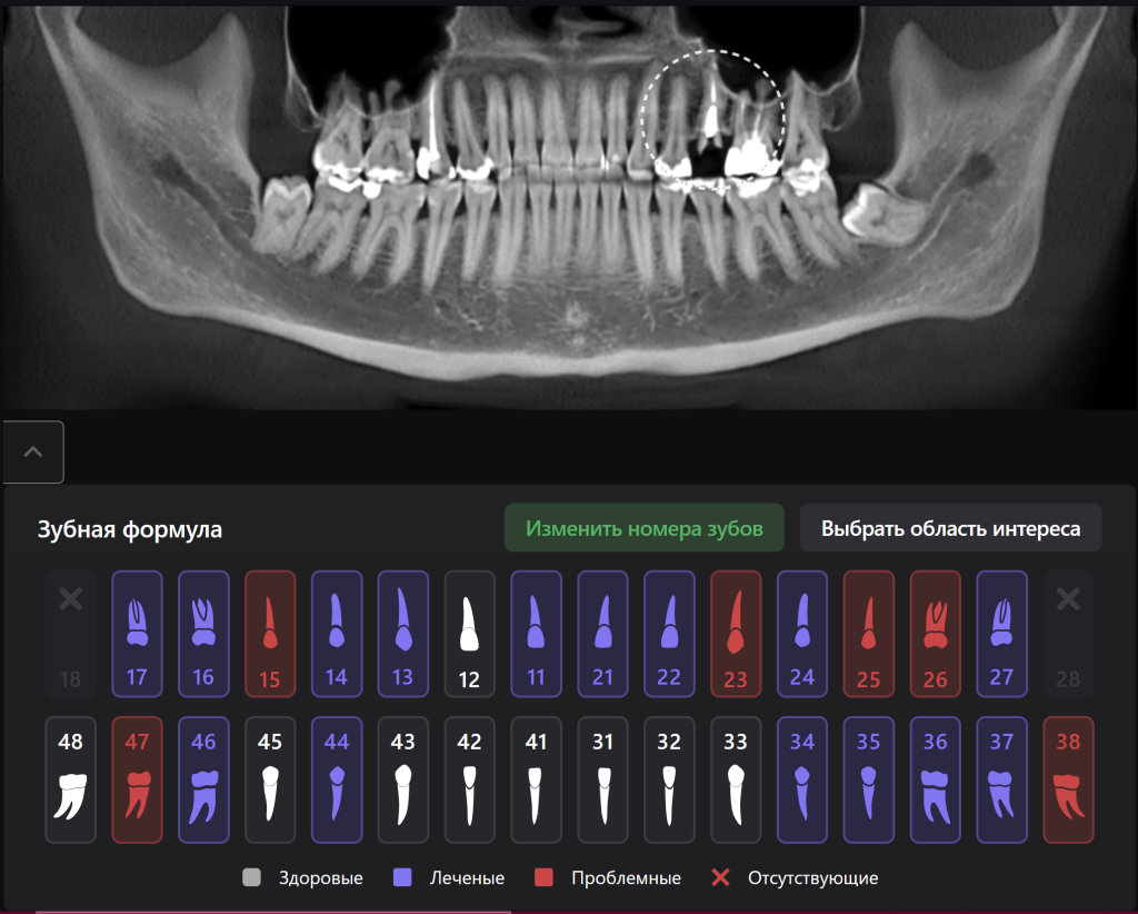 Случай из практики - планирование одномоментной имплантации с помощью ИИ Diagnocat 2 Случай из практики - планирование одномоментной имплантации с помощью ИИ Diagnocat 1