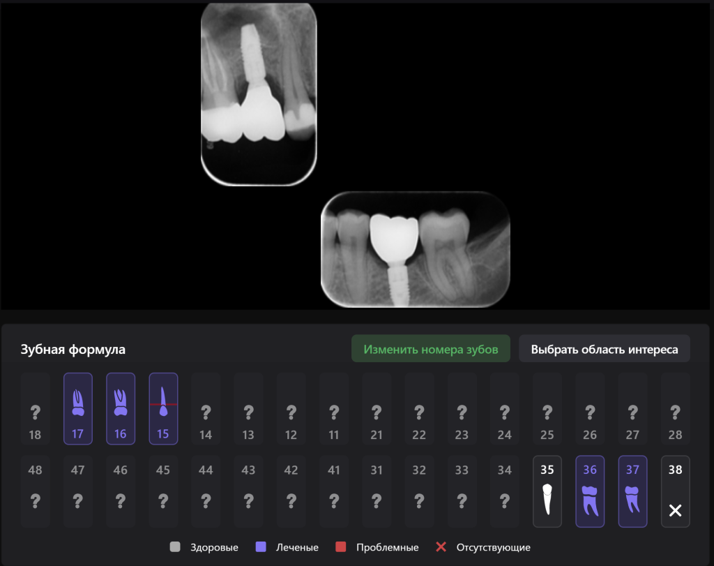 Пример из практики - планирование имплантации в области зуба 3.6 20 Пример из практики - планирование имплантации в области зуба 3.6 19