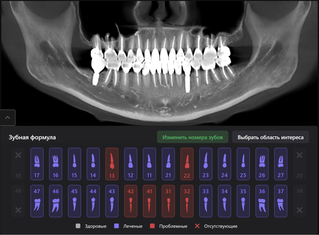 Случай из практики - планирование тотальной ортопедической реабилитации 20 Случай из практики - планирование тотальной ортопедической реабилитации 19