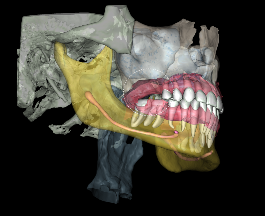 Implant treatment planning 4 Implant treatment planning 3