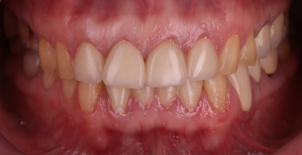 Total prosthetic rehabilitation - case study 4 Total prosthetic rehabilitation - case study 3