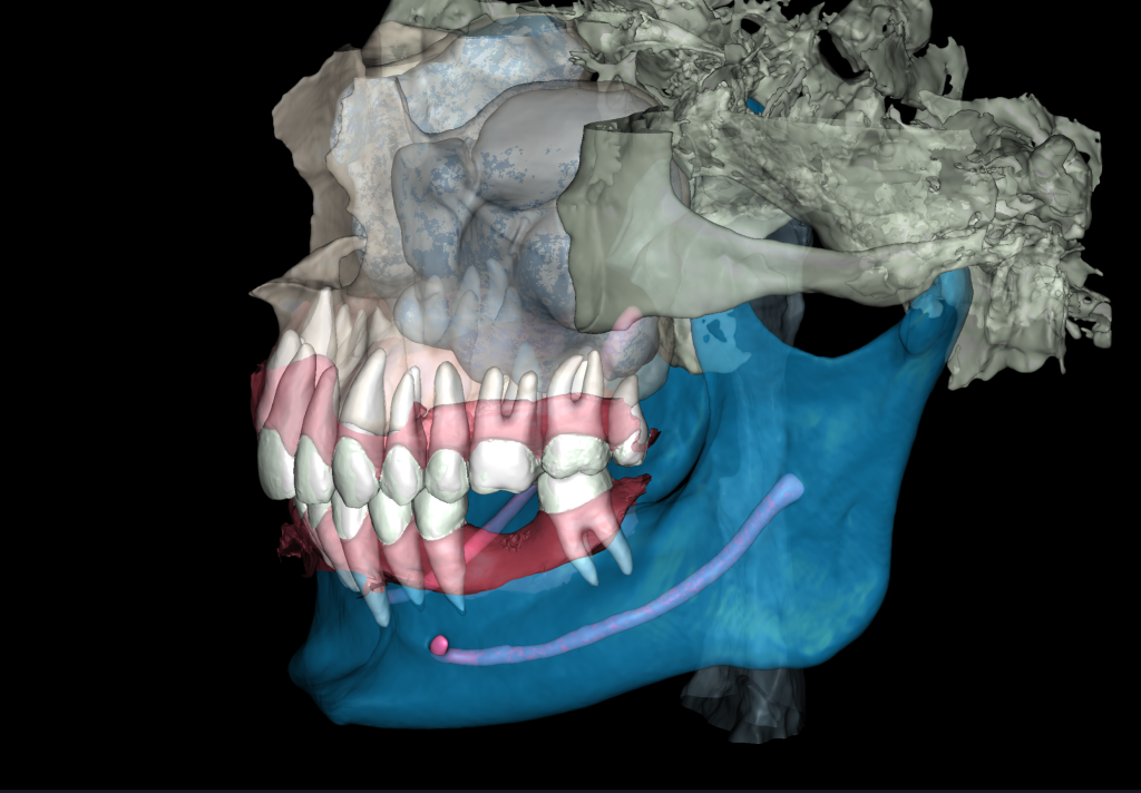 Case study - Implant planning supported with Diagnocat AI 4 Case study - Implant planning supported with Diagnocat AI 3