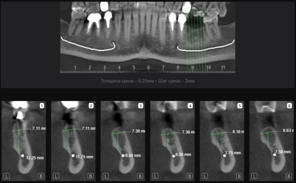 Случай из практики - планирование имплантации вместе с ИИ Diagnocat 4 Случай из практики - планирование имплантации вместе с ИИ Diagnocat 3
