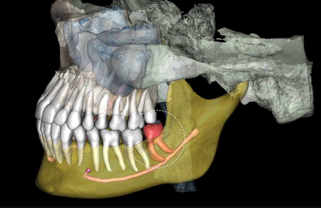 Case study - Treatment plan for atraumatic extractions 4 Case study - Treatment plan for atraumatic extractions 3
