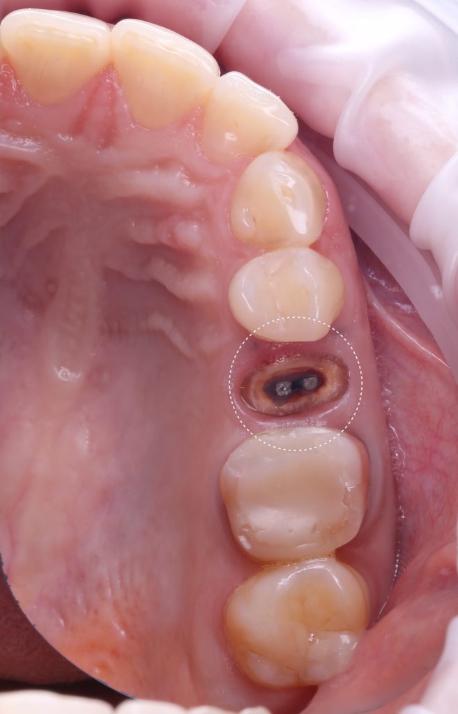 Case study: Implant planning for missing tooth 25 (universal 13) 4 Case study: Implant planning for missing tooth 25 (universal 13) 3