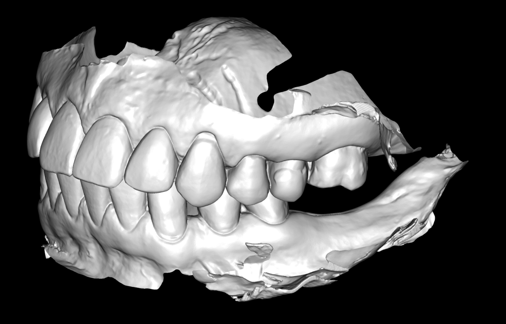 Implant placement using Diagnocat modules 4 Implant placement using Diagnocat modules 3