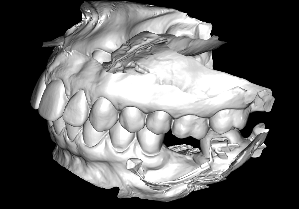 Case study: Implant planning for missing 36 (Universal 19) 4 Case study: Implant planning for missing 36 (Universal 19) 3