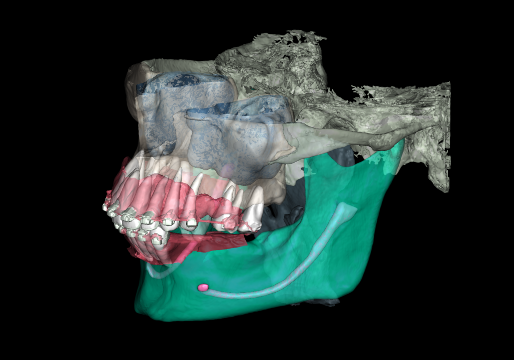 Case study - Reconstruction of the alveolar ridge using Diagnocat AI 4 Case study - Reconstruction of the alveolar ridge using Diagnocat AI 3