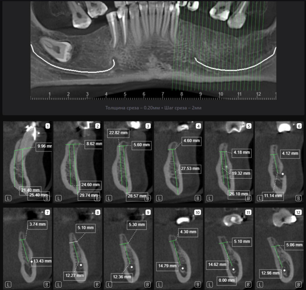 Пример из практики - планирование реконструкции альвеолярного гребня вместе с Diagnocat 4 Пример из практики - планирование реконструкции альвеолярного гребня вместе с Diagnocat 3