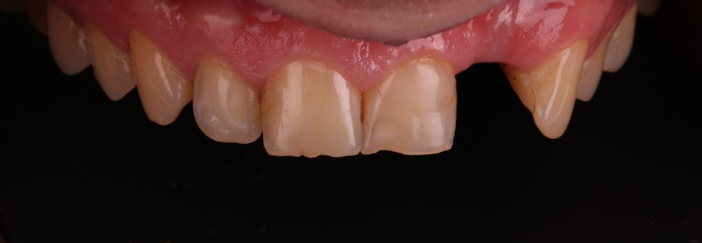 Aesthetic zone implant plan 4 Aesthetic zone implant plan 3