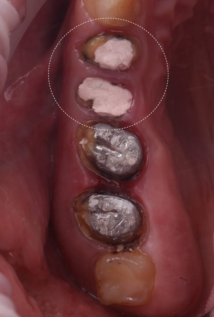 Fallstudie - Kieferorthopädischer Behandlungsplan nach Zahnextraktion 4 Fallstudie - Kieferorthopädischer Behandlungsplan nach Zahnextraktion 3