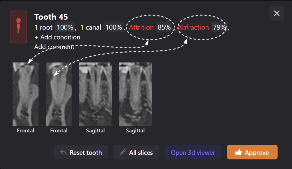 Total prosthetic rehabilitation - case study 6 Total prosthetic rehabilitation - case study 5