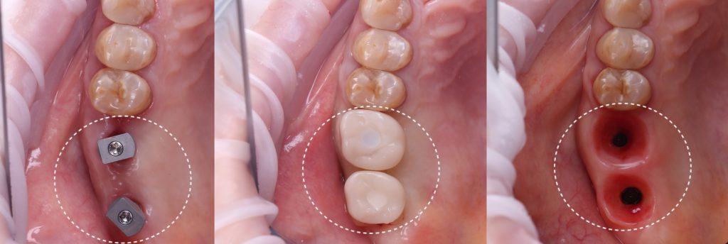 Implant treatment planning 6 Implant treatment planning 5
