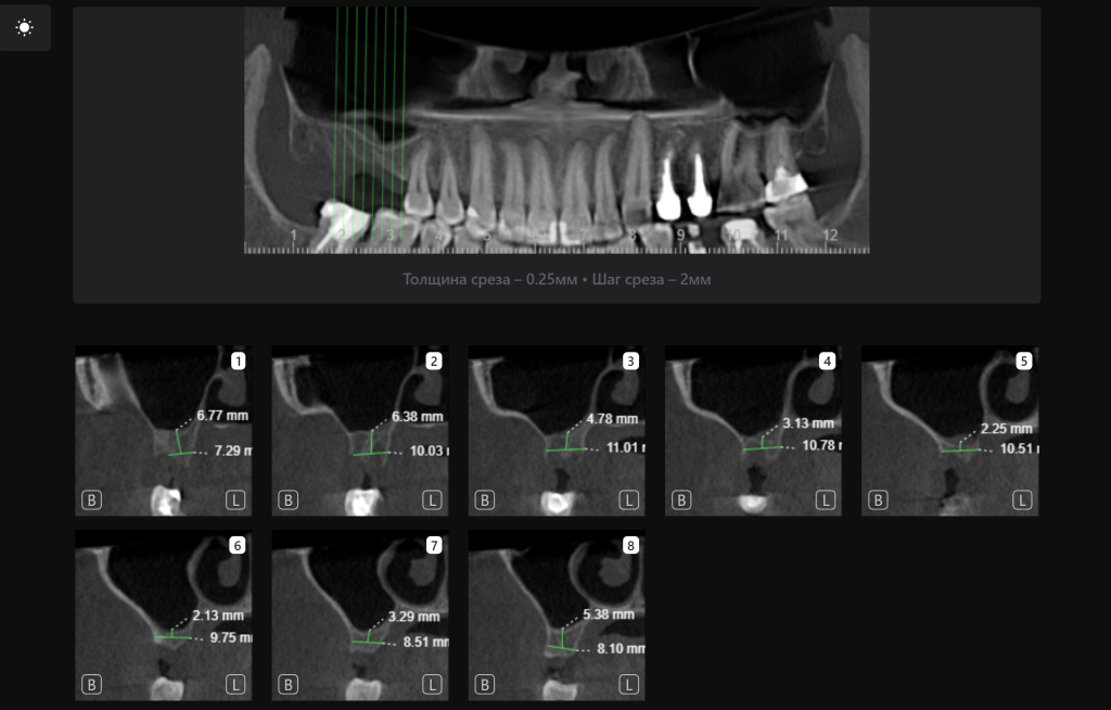 Планирование имплантации 6 Планирование имплантации 5