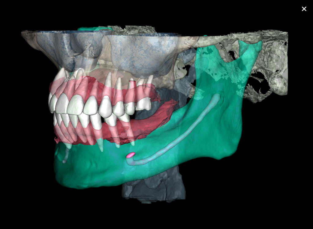 Implant placement using Diagnocat modules 6 Implant placement using Diagnocat modules 5