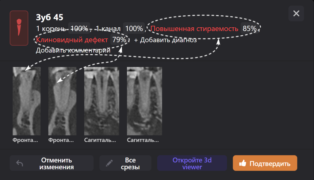 Случай из практики - планирование тотальной ортопедической реабилитации 6 Случай из практики - планирование тотальной ортопедической реабилитации 5