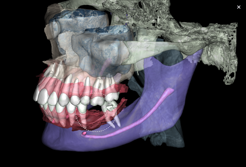 Case study: Implant planning for missing 36 (Universal 19)