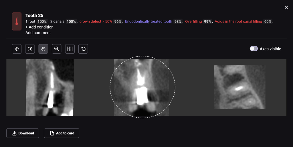 Case study: Implant planning for missing tooth 25 (universal 13) 6 Case study: Implant planning for missing tooth 25 (universal 13) 5