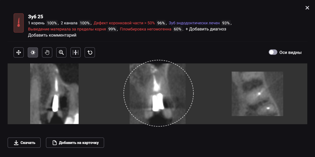 Случай из практики - планирование одномоментной имплантации с помощью ИИ Diagnocat 6 Случай из практики - планирование одномоментной имплантации с помощью ИИ Diagnocat 5