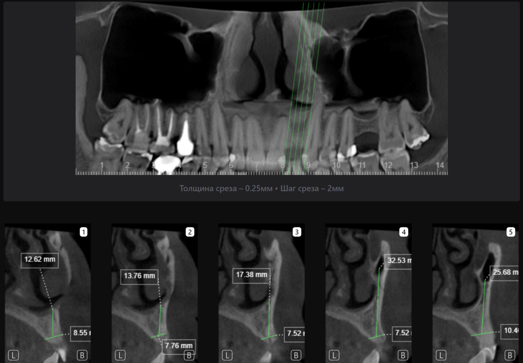 Планирование имплантации зуба в эстетически важной зоне 6 Планирование имплантации зуба в эстетически важной зоне 5