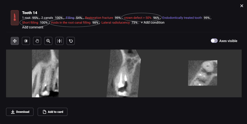 Fallstudie - Kieferorthopädischer Behandlungsplan nach Zahnextraktion 6 Fallstudie - Kieferorthopädischer Behandlungsplan nach Zahnextraktion 5