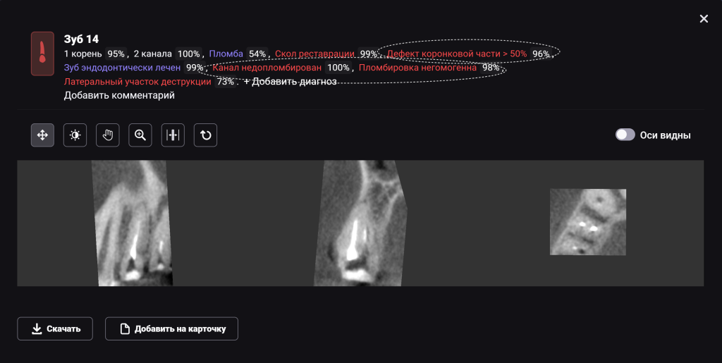 Случай из практики - экструзия зуба с помощью ортодонтической конструкции 6 Случай из практики - экструзия зуба с помощью ортодонтической конструкции 5