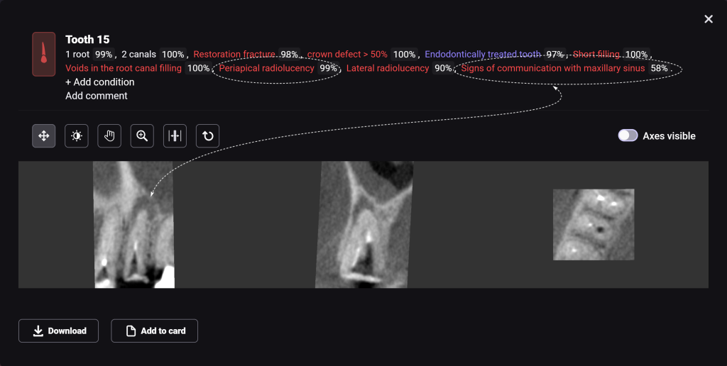 Fallstudie - Kieferorthopädischer Behandlungsplan nach Zahnextraktion 8 Fallstudie - Kieferorthopädischer Behandlungsplan nach Zahnextraktion 7