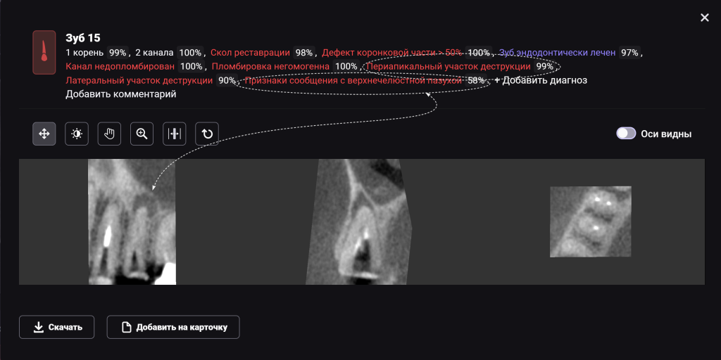 Случай из практики - экструзия зуба с помощью ортодонтической конструкции 8 Случай из практики - экструзия зуба с помощью ортодонтической конструкции 7