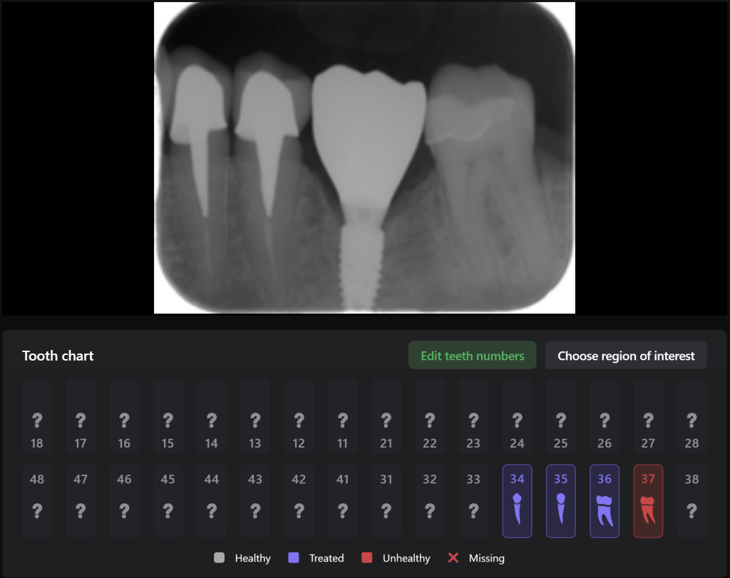 Case study - Implant planning supported with Diagnocat AI 8 Case study - Implant planning supported with Diagnocat AI 7