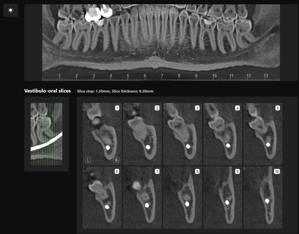 Case study - Treatment plan for atraumatic extractions 8 Case study - Treatment plan for atraumatic extractions 7